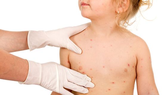 La dermatite herpétiforme, des signes de la maladie cœliaque sur la peau?