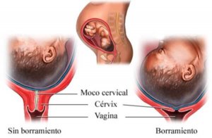 Qu Est Ce Que L Effacement Du Col De L Uterus Etre Parents