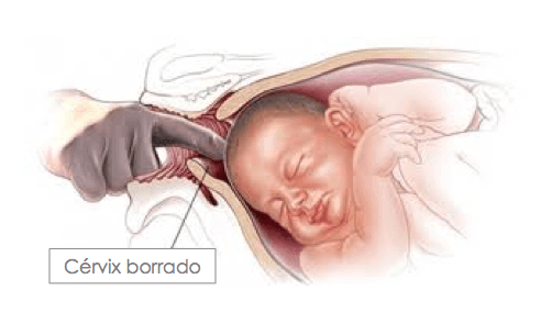 Schéma expliquant où se trouve le cervix, qui joue un rôle important dans l'effacement du col de l'utérus