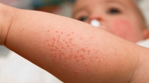 Faites attention à ces petits boutons et irritations de la peau
