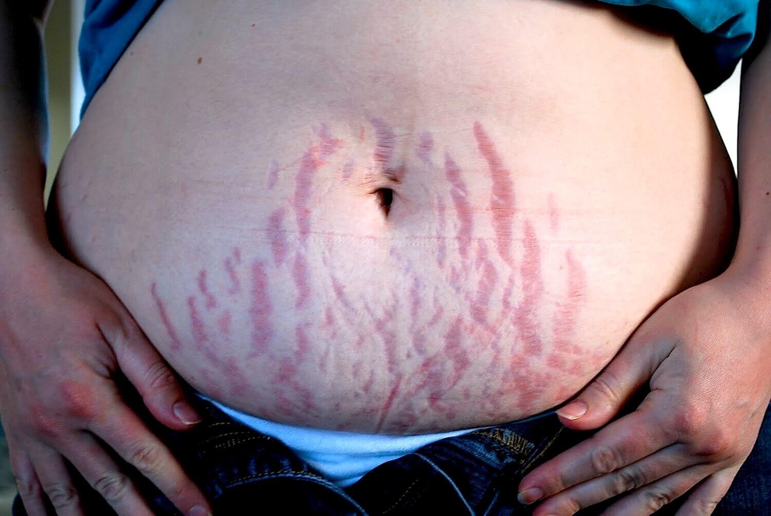 ventre grossesse vergetures