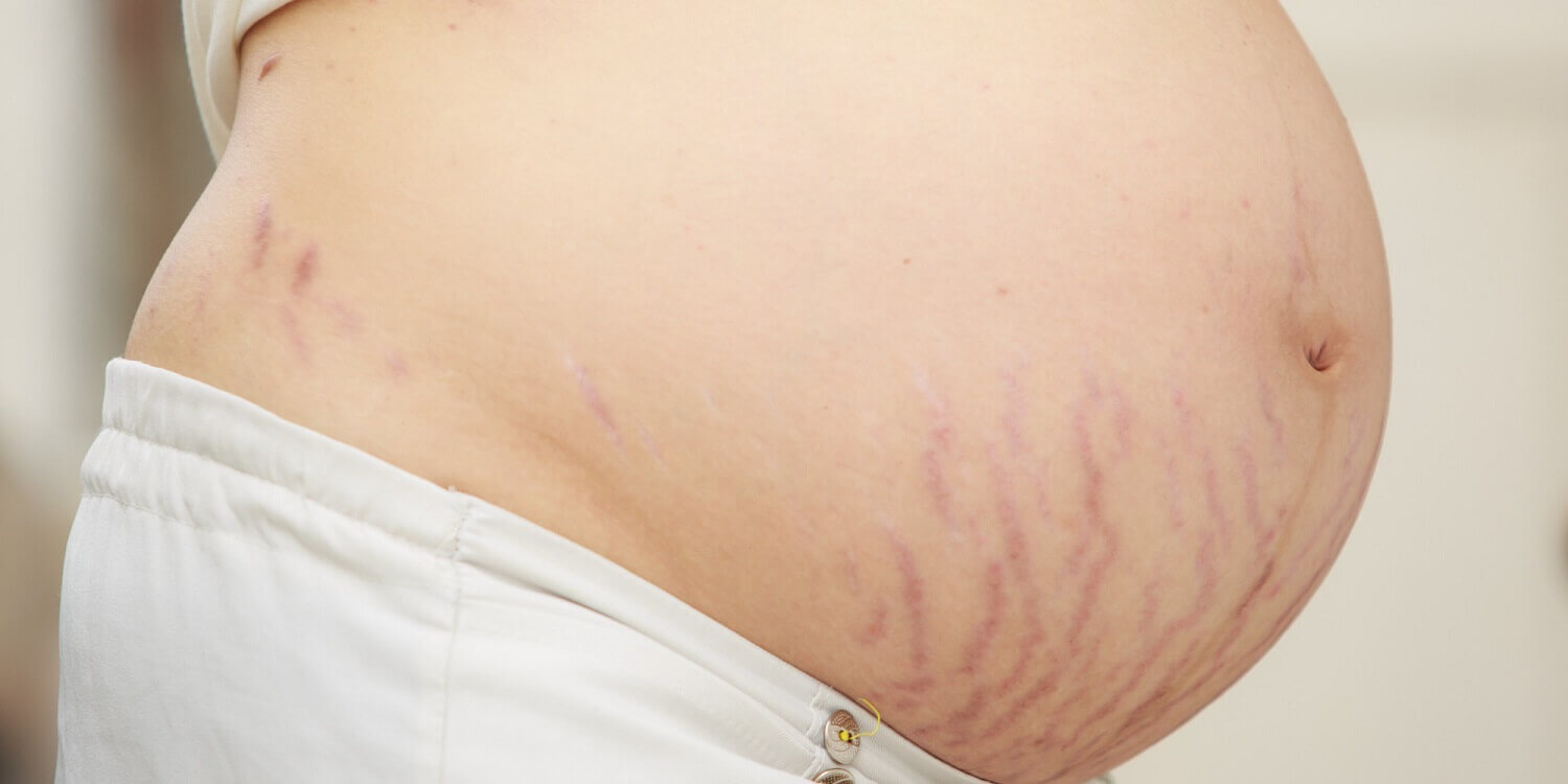 Ventre de femme enceinte vergetures