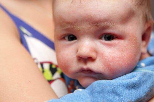 Soigner les éruptions cutanées des bébés