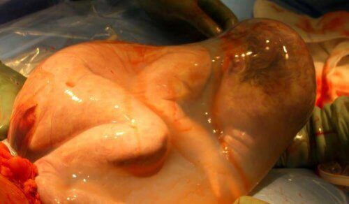 La naissance coiffée est celle dans laquelle l'enfant naît avec le sac amniotique intact.