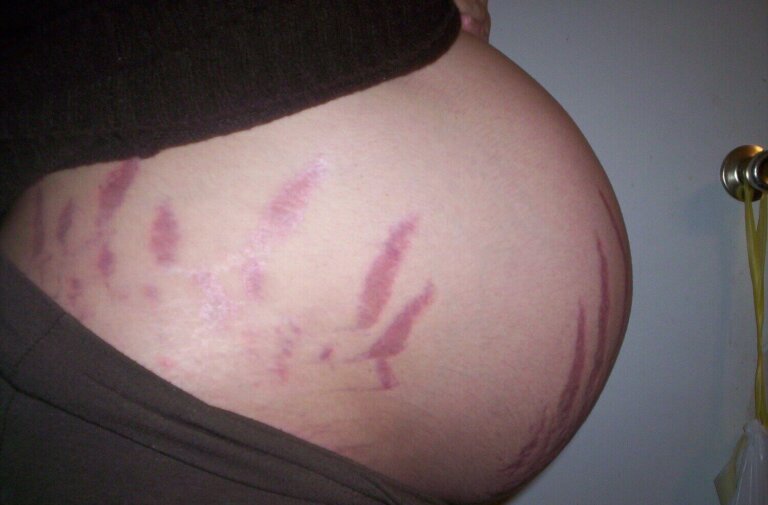 Pourquoi les vergetures apparaissent-elles pendant la grossesse ?