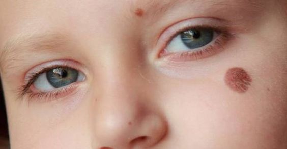 Certaines taches de naissance disparaissent au cours des premières années de vie