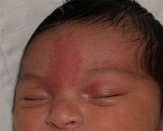 Les différentes taches de naissance sont de plus en plus fréquentes