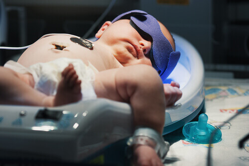 Tout savoir sur la jaunisse infantile