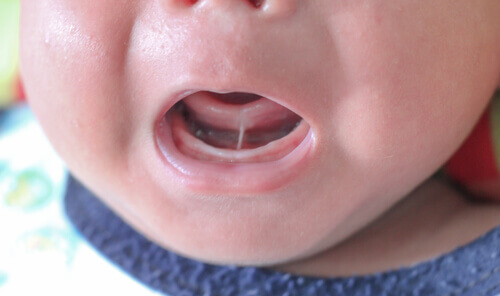 Ankyloglossie ou frein lingual court chez les enfants