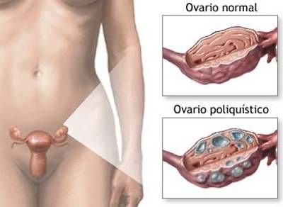 Différence entre un ovaire normal et un ovaire polykystique
