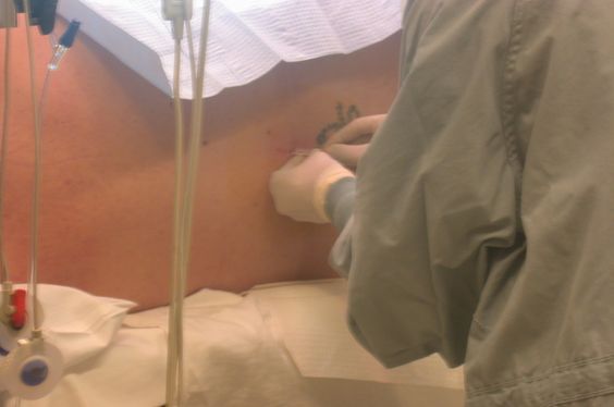 L'anesthésie péridurale ou rachidienne est injectée lors d'opérations au niveau du ventre, du bassin, des jambes ou des pieds