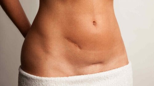 Atténuez et traitez vos cicatrices aujourd'hui grâce à nos meilleurs conseils