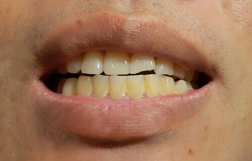 L’apparition de taches sur les dents définitives