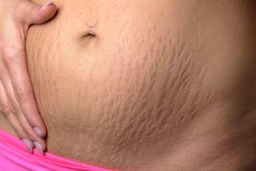 Les vergetures après la grossesse