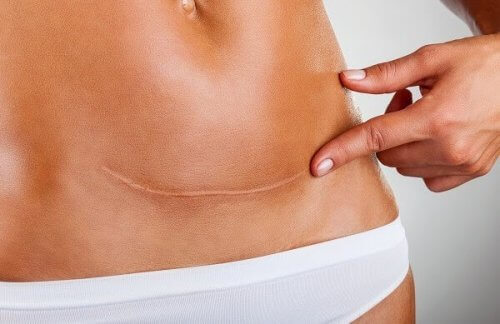 femme montrant sa cicatrice césarienne