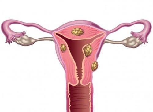 Les fibromes utérins et l'infertilité - Être parents