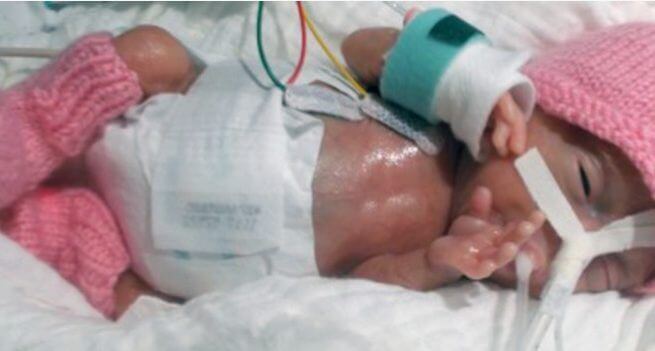 L'amour a permis aux parents d'Emilia d'y croire et de prendre soin de cette petite vie