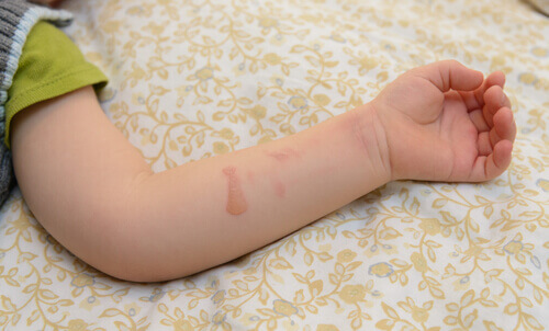 Que faire si mon enfant se brûle avec de l'eau chaude ?