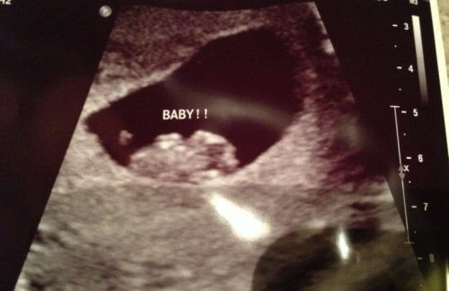 Le succès de la méthode Ramzi pour connaitre le sexe du bébé