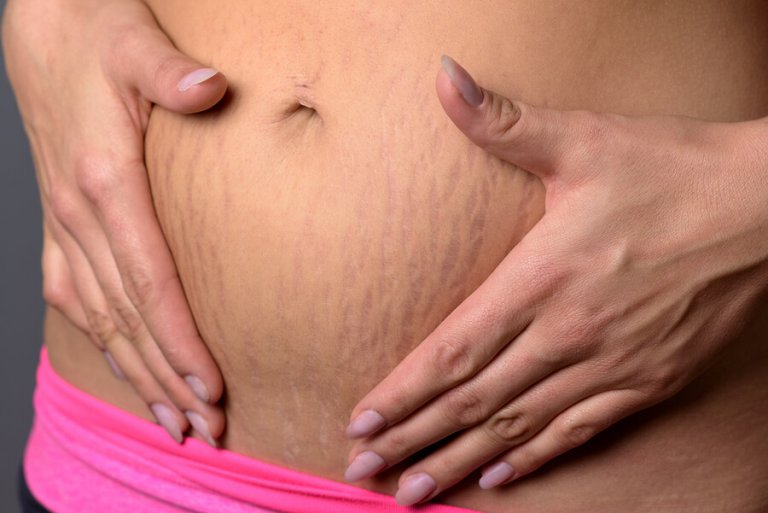 Comment éliminer les vergetures pendant la grossesse
