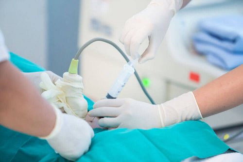 Qu'est-ce que l'amniocentèse ?