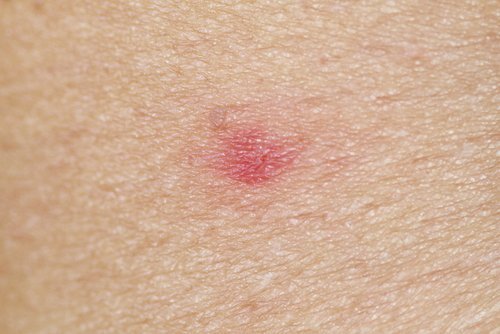 Les piqûres de guêpe