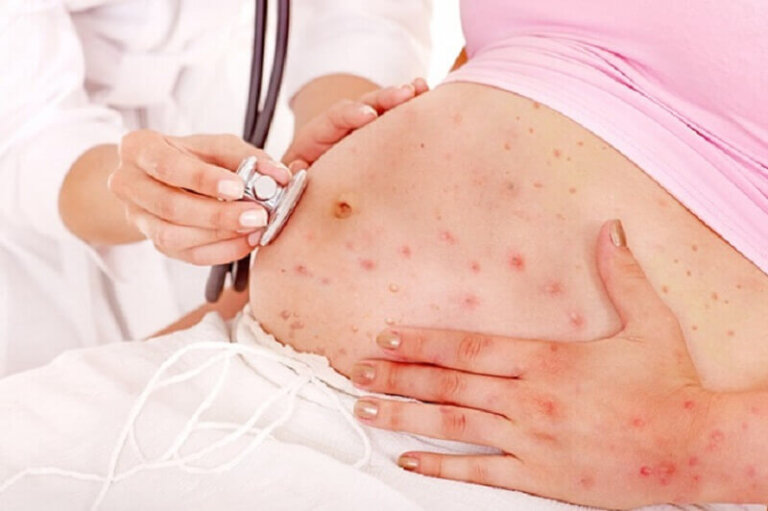 Qu'est-ce que la varicelle congénitale ?