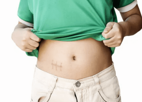 L'appendicite chez les enfants : ce qu'il faut savoir