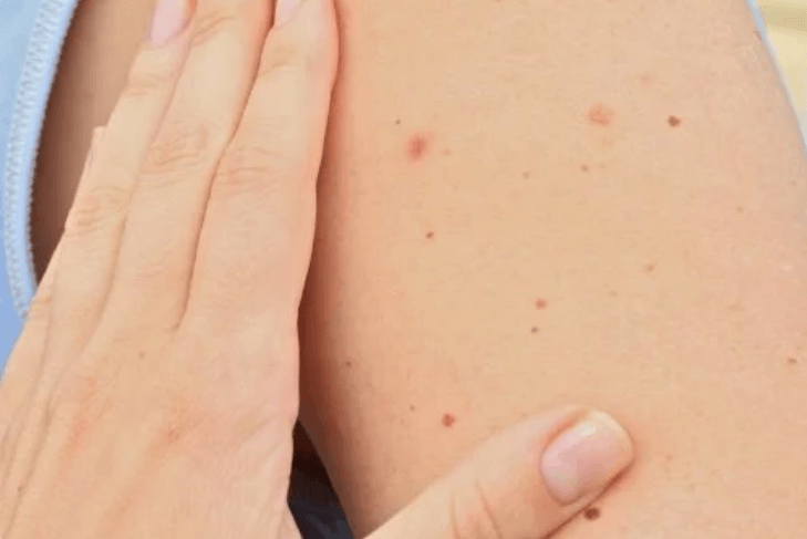 Les différents types de grains de beauté