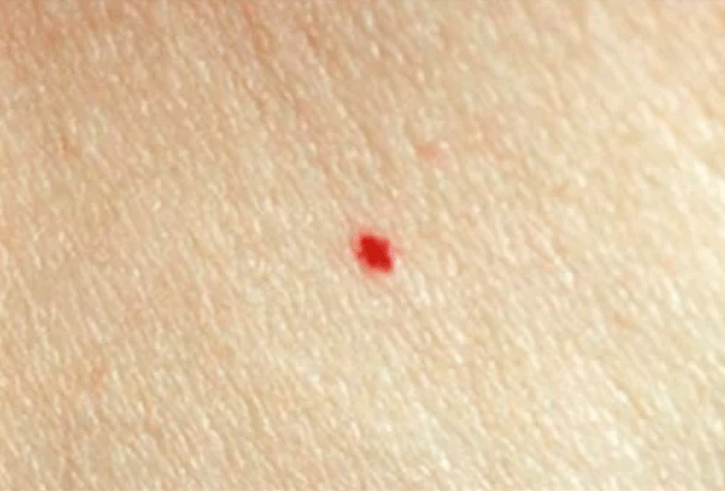 Les différents types de grains de beauté