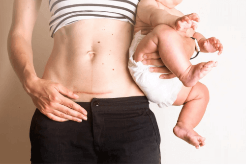 Comment prendre soin des points de suture après l'accouchement ?