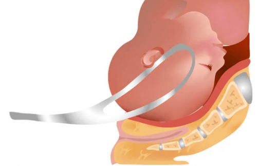 Qu'est-ce que l'accouchement par forceps ?