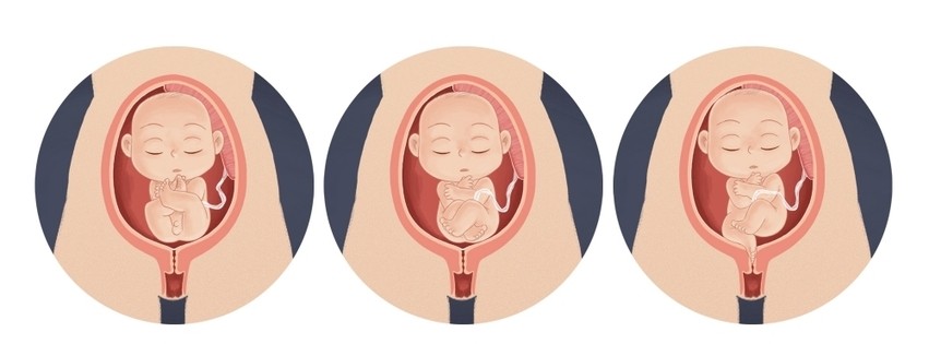 Lors d'un accouchement par le siège, il existe cinq types de positions qui déterminent ou non la césarienne ou l'accouchement vaginal.