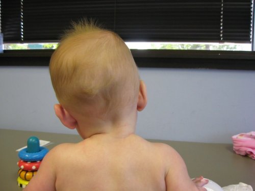 scoliose chez les enfants