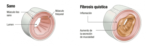 fibrose kystique