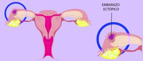 Le schéma d'explication d'une grossesse extra-utérine