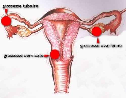 Les différents types de grossesse extra-utérine