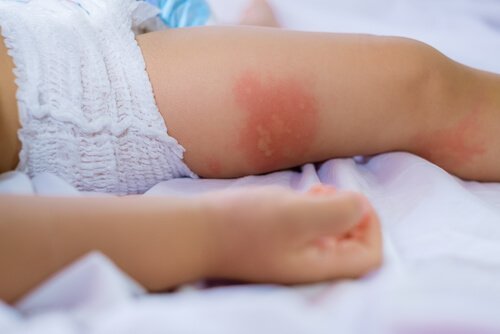 allergies alimentaires chez les enfants