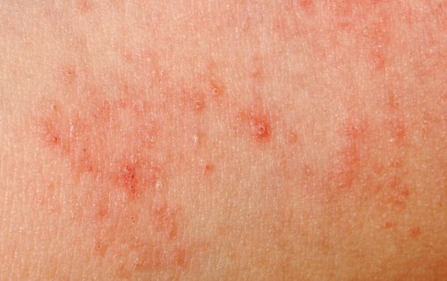 allergie à la sueur chez les enfants