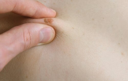 grains de beauté chez les enfants