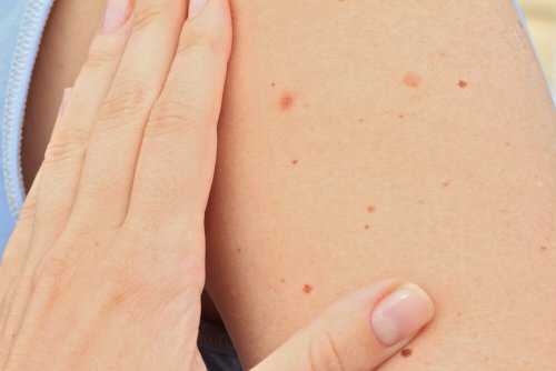 grains de beauté chez les enfants