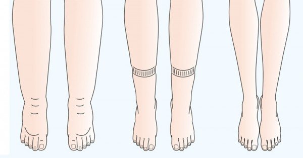 Les problèmes de circulation sanguine pendant la grossesse ont lieu généralement dans les jambes et la vulve.