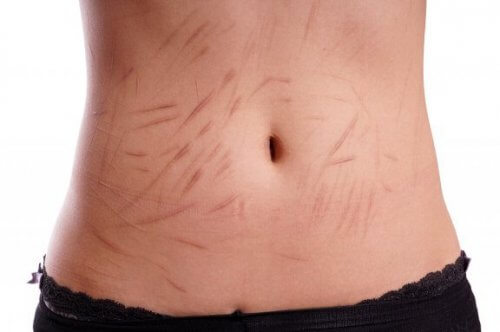L'automutilation chez les adolescents, qu'y a-t-il derrière ?