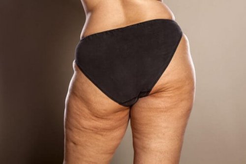 Quelques conseils pour combattre la cellulite