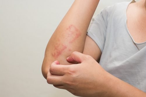 L'un des remèdes contre le psoriasis est l'huile de coco.