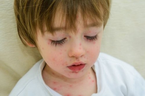 La varicelle fait partie des maladies contagieuses que l'on retrouve beaucoup à l'école.
