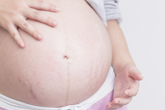 Comment prévenir les vergetures pendant la grossesse ?
