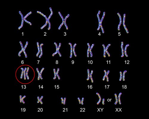 Les statistiques montrent que le syndrome de Patau survient chez un enfant sur 10 000.