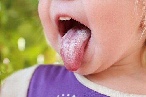 Le Muguet buccal est provoqué par le même champignon qui cause l'érythème fessier et les infections vaginales.