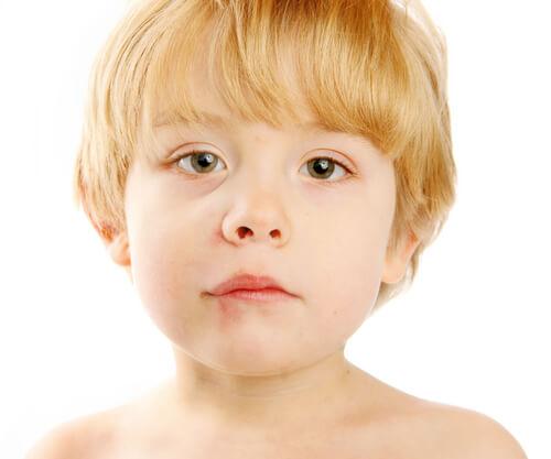 Un enfant avec une perlèche